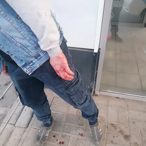 Защищал правопорядок - поранил лицо
